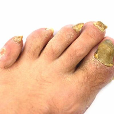An Effective Way to Treat Toenail Fungus – Hydrogen Peroxide