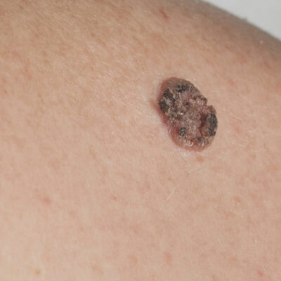 Carcinoma – Types, symptoms, and other important information you should know