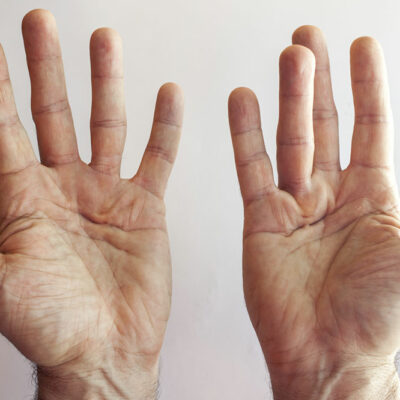 4 hand exercises for Dupuytren’s contracture patients