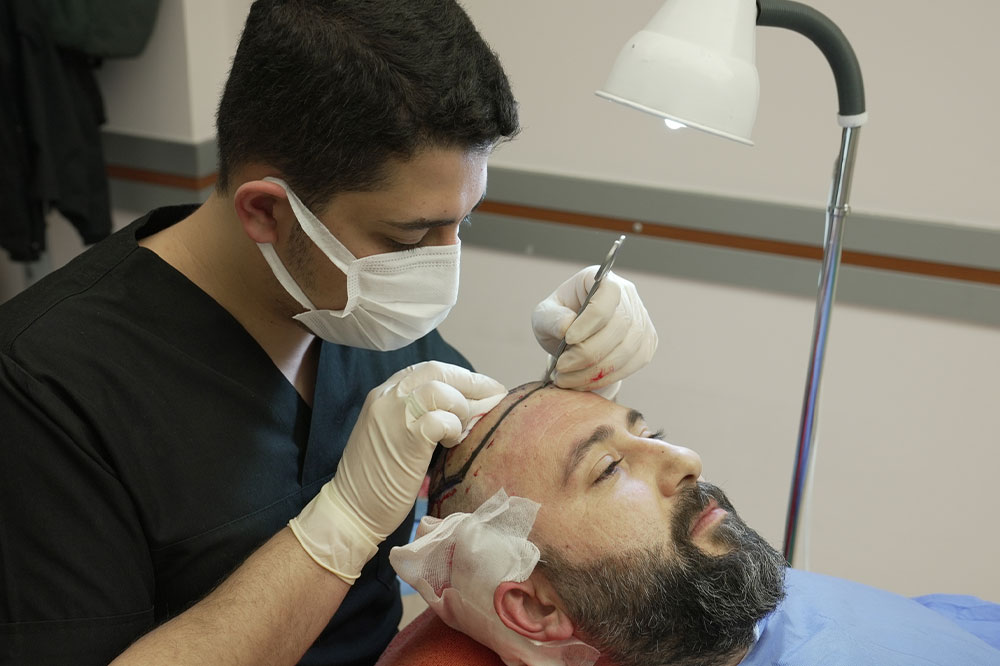 Everything to Know About a Hair Transplant in Turkey